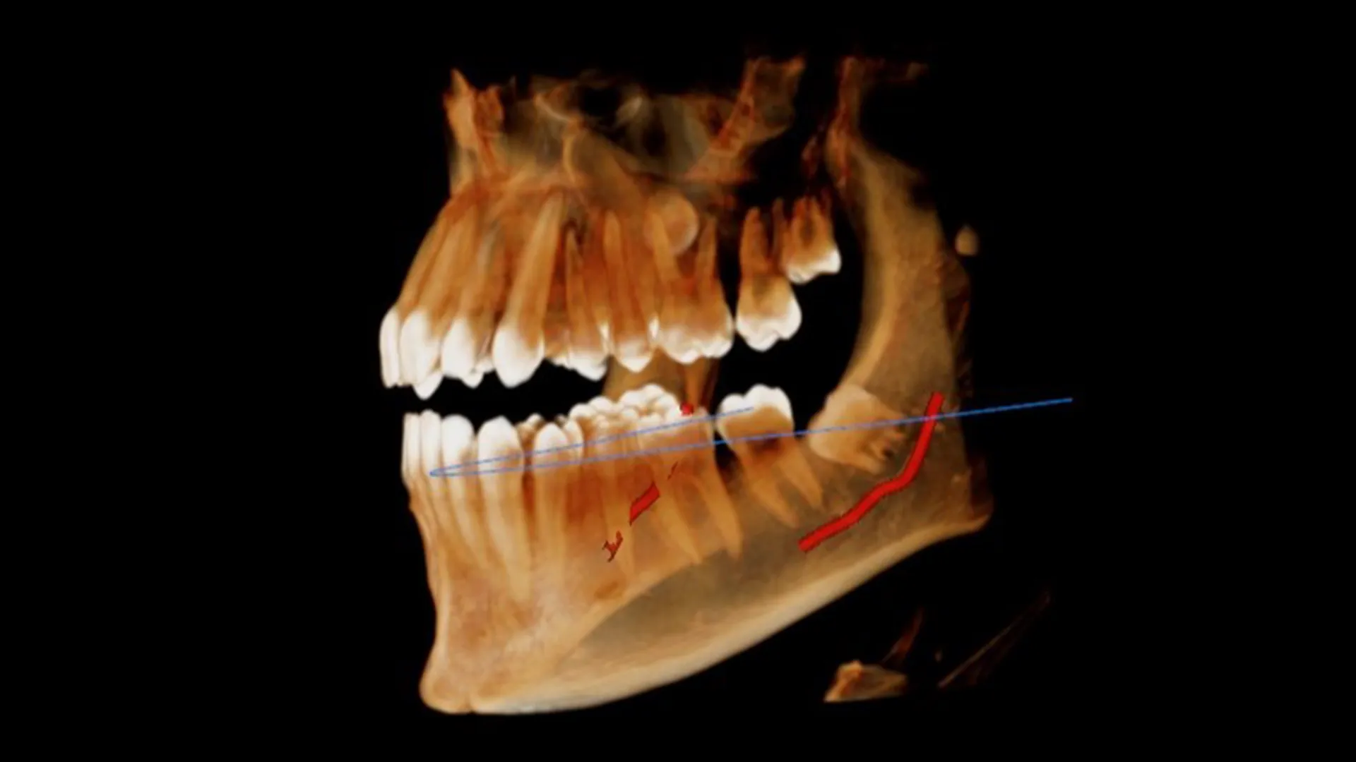Schéma CBCT : analyse 3D d’une dent de sagesse et de sa proximité avec les structures anatomiques
