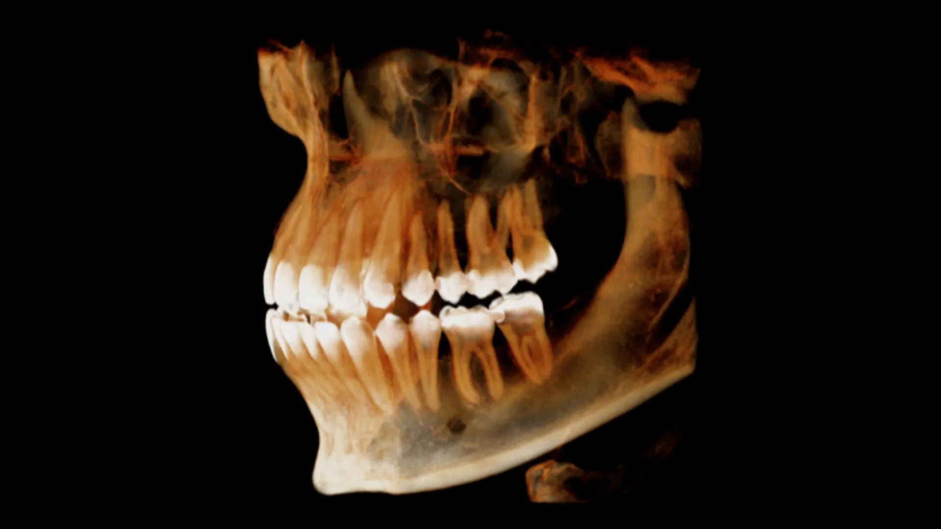 Schéma CBCT : scanner dentaire 3D (Cone Beam) pour visualiser les structures osseuses