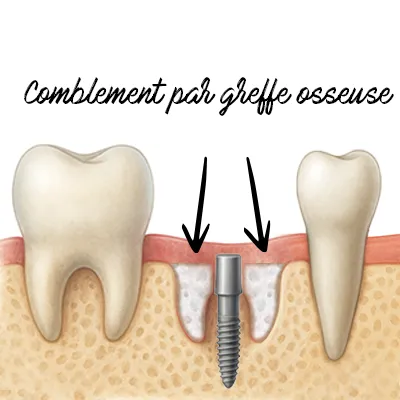 Schéma du comblement osseux autour de l’implant dentaire