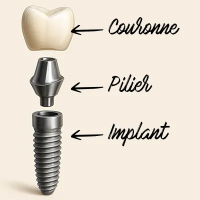 Schéma de la composition d’un implant dentaire (implant, pilier, couronne)