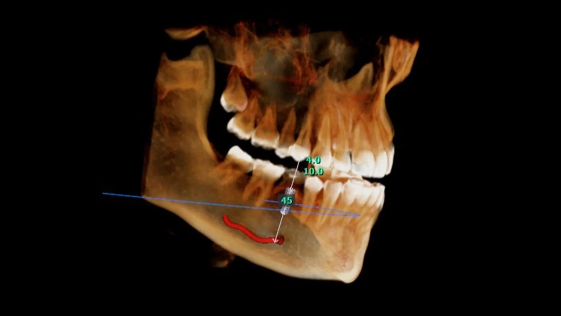 Schéma CBCT 3D pour la pose d’implants dentaires